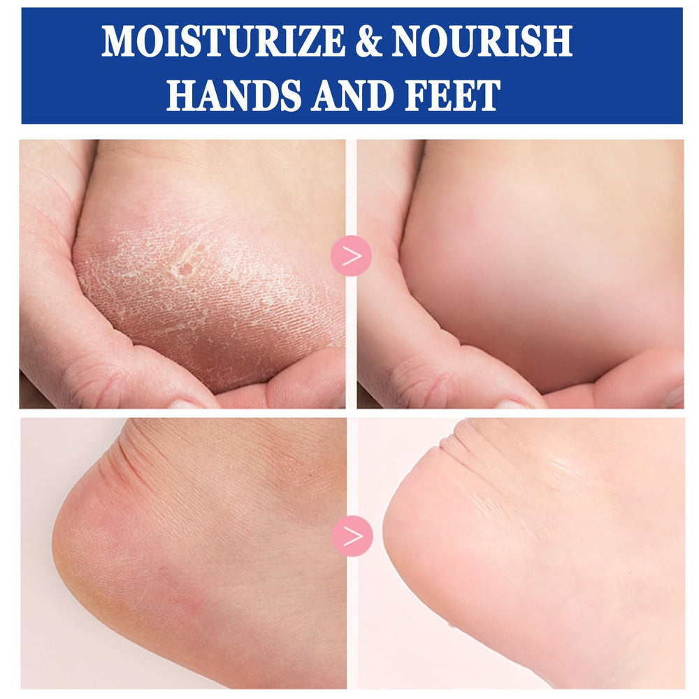 Anweina foot cream suitable for feet, hands, elbows and more.