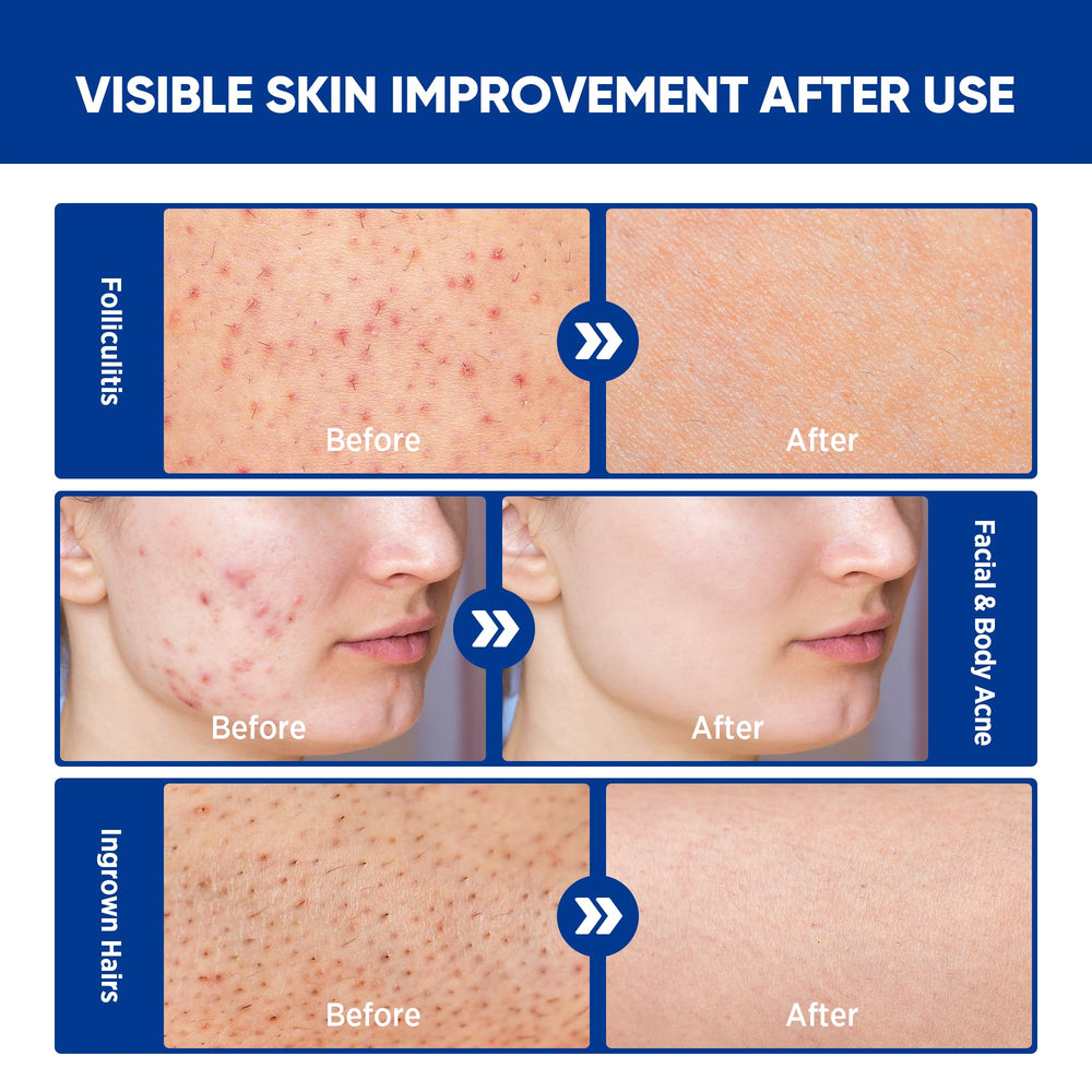 AOSORW Folliculitis Cream applied on the scalp for multi-area care.