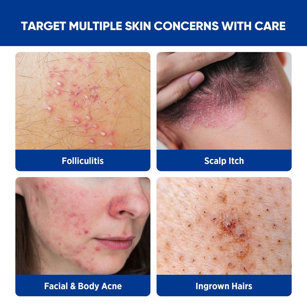 AOSORW herbal extracts with tea tree oil support scalp and skin comfort.