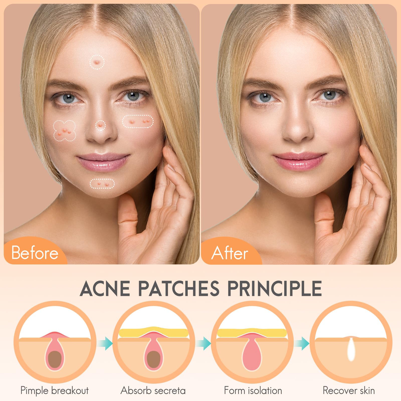 AOAWI L-shaped strip patch fits chin, nose, and cheek acne neatly.