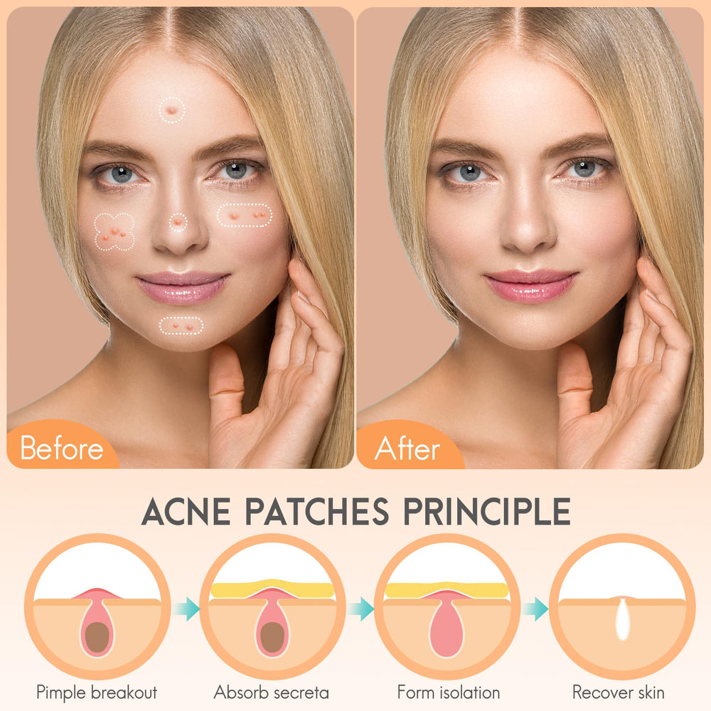 AOAWI L-shaped strip patch fits chin, nose, and cheek acne neatly.