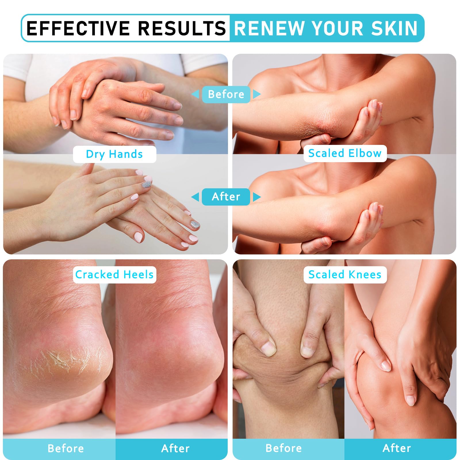 Aphesia Urea Cream 40% fast absorption for daily use.