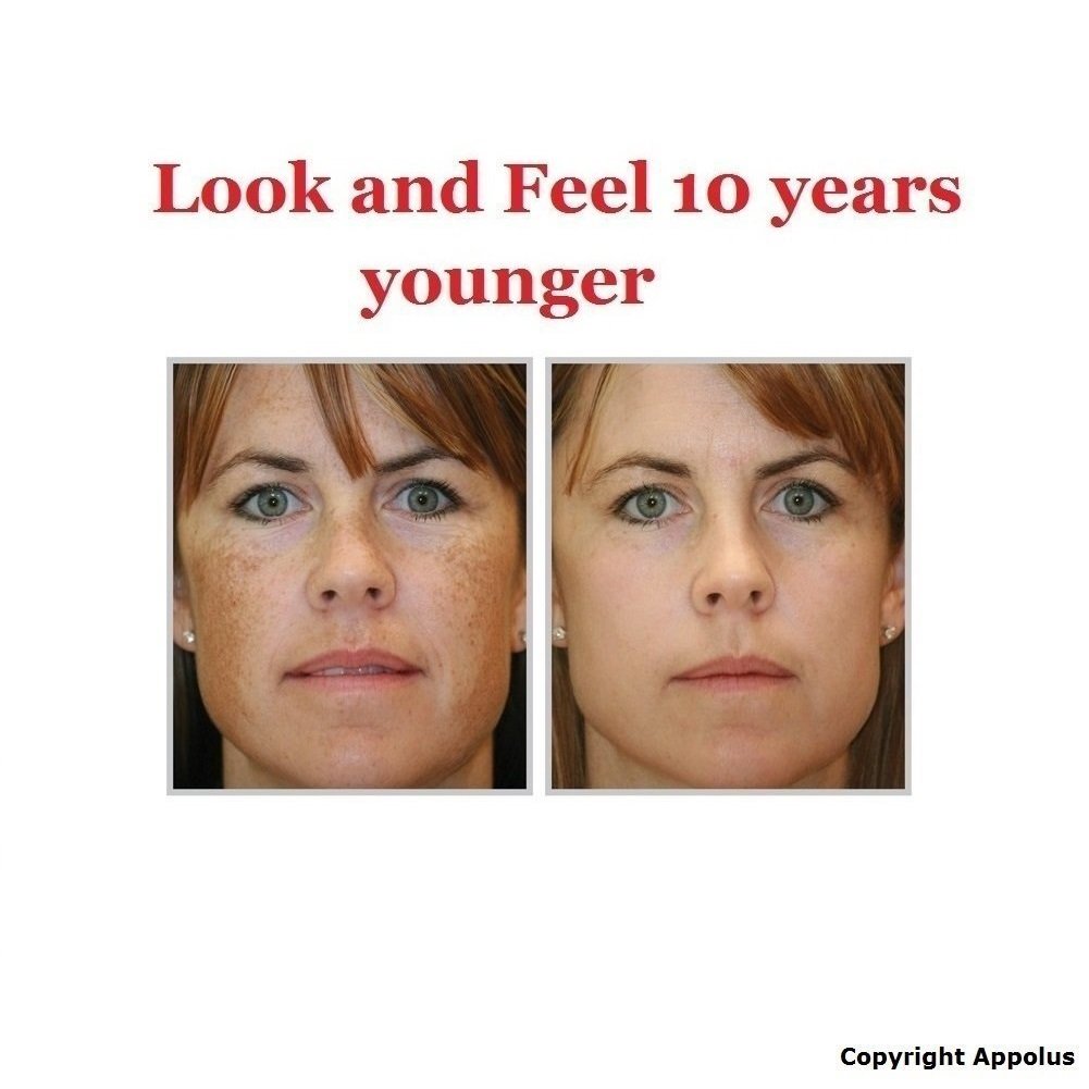 Appolus Microdermabrasion Charging Base for cordless use