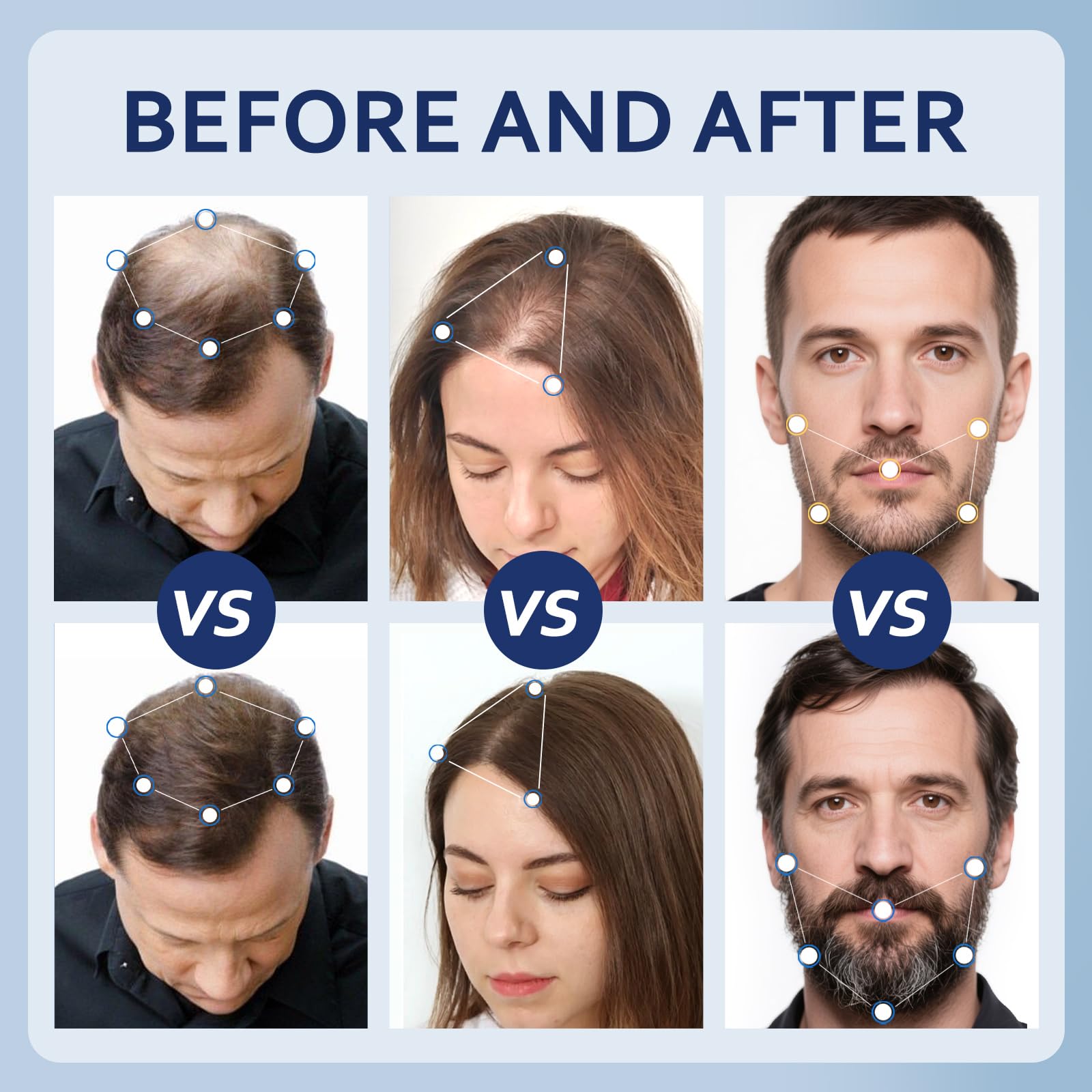 Application cuir chevelu Artimore Minoxidil, manipulation simple et contrôle précis