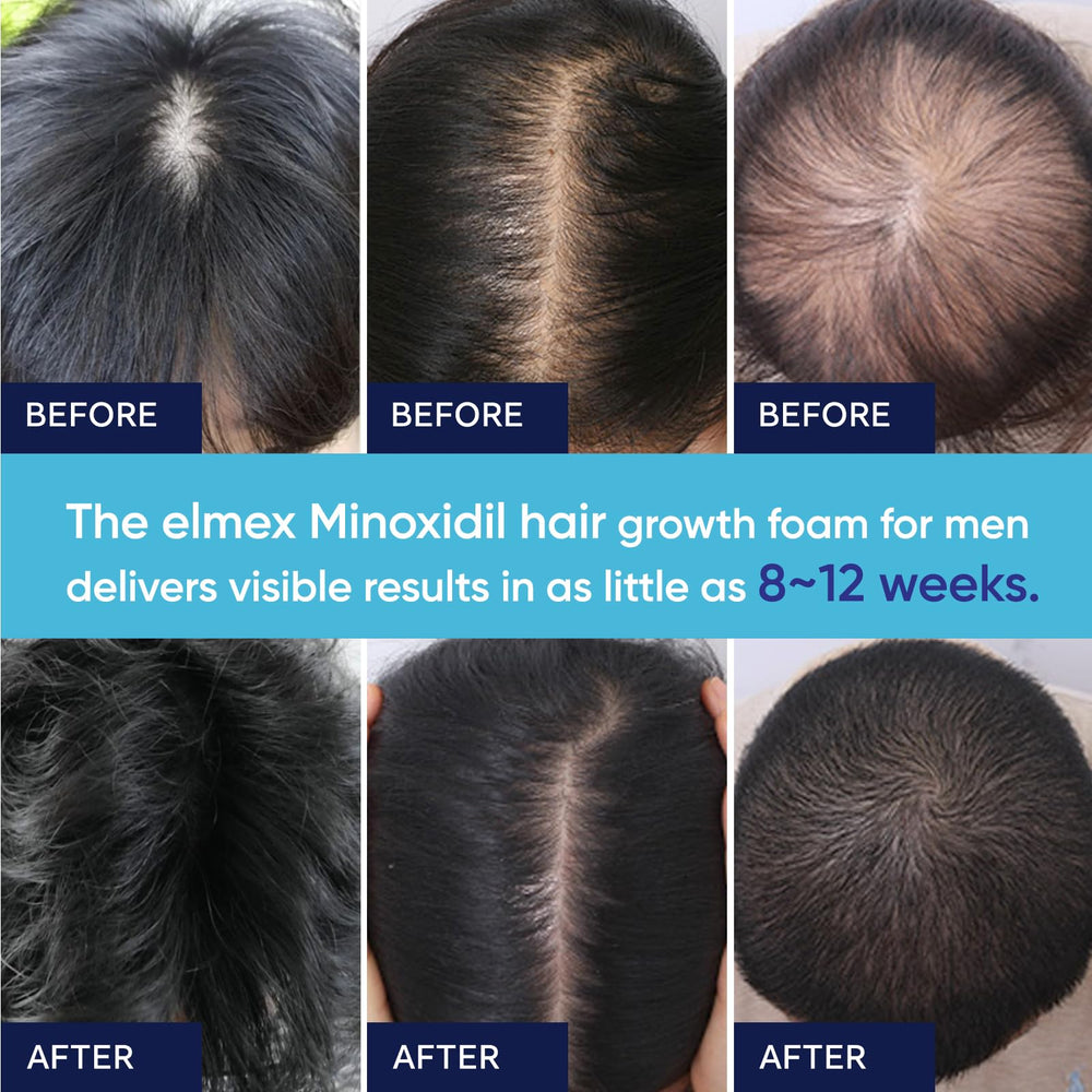 Artimore Minoxidil Foam hair regrowth potential shown visually.