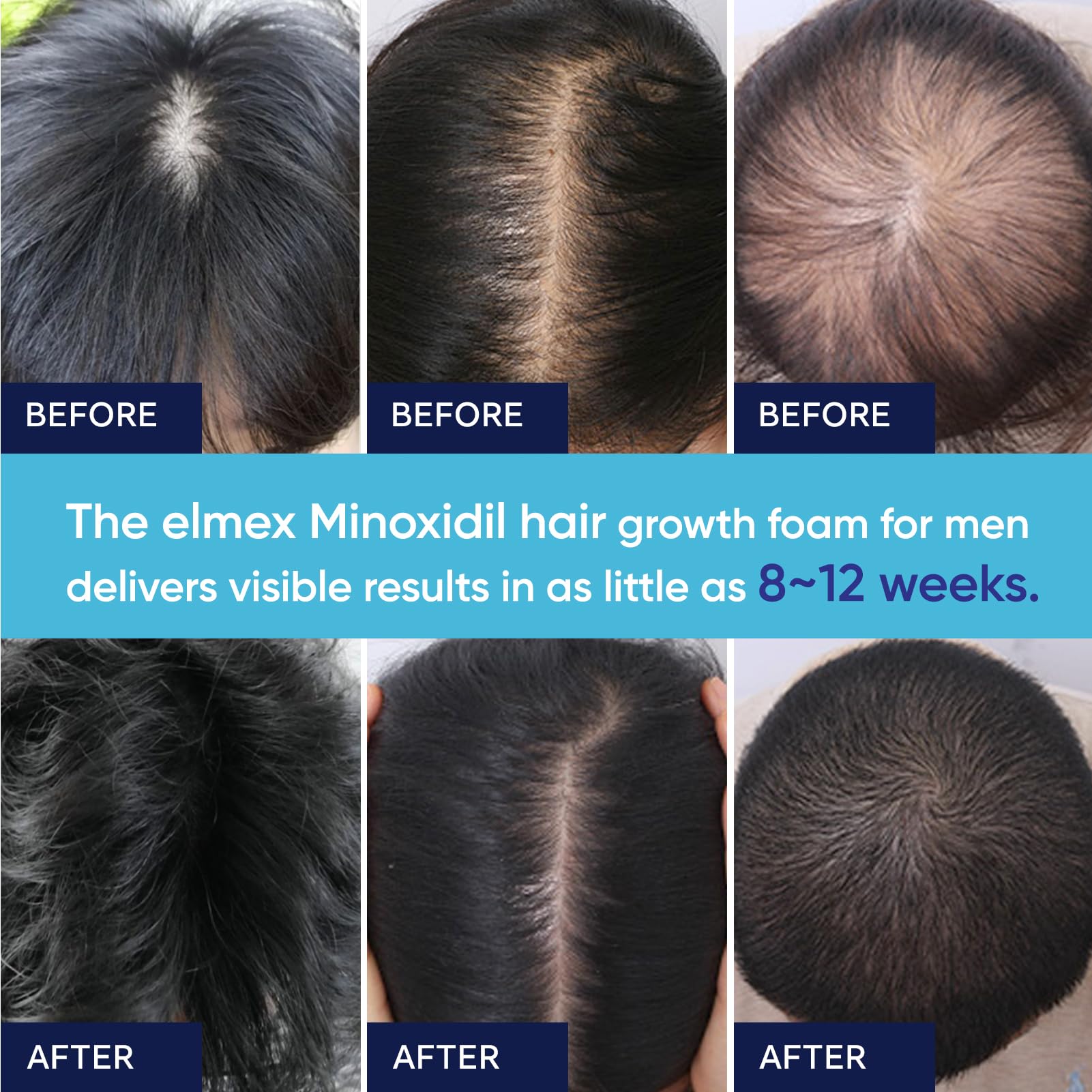 Artimore minoxidil foam helps achieve a thicker appearance over time