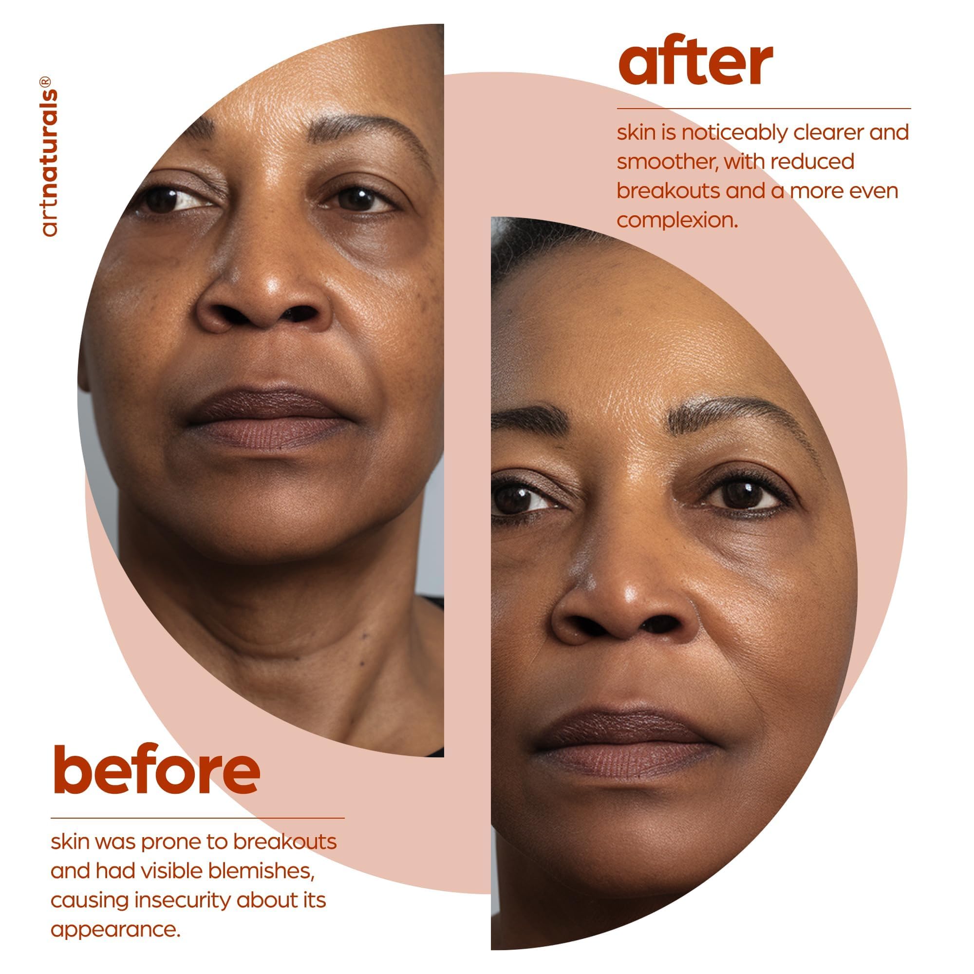 Artnaturals serum on skin showing shine reduction and smoothing.