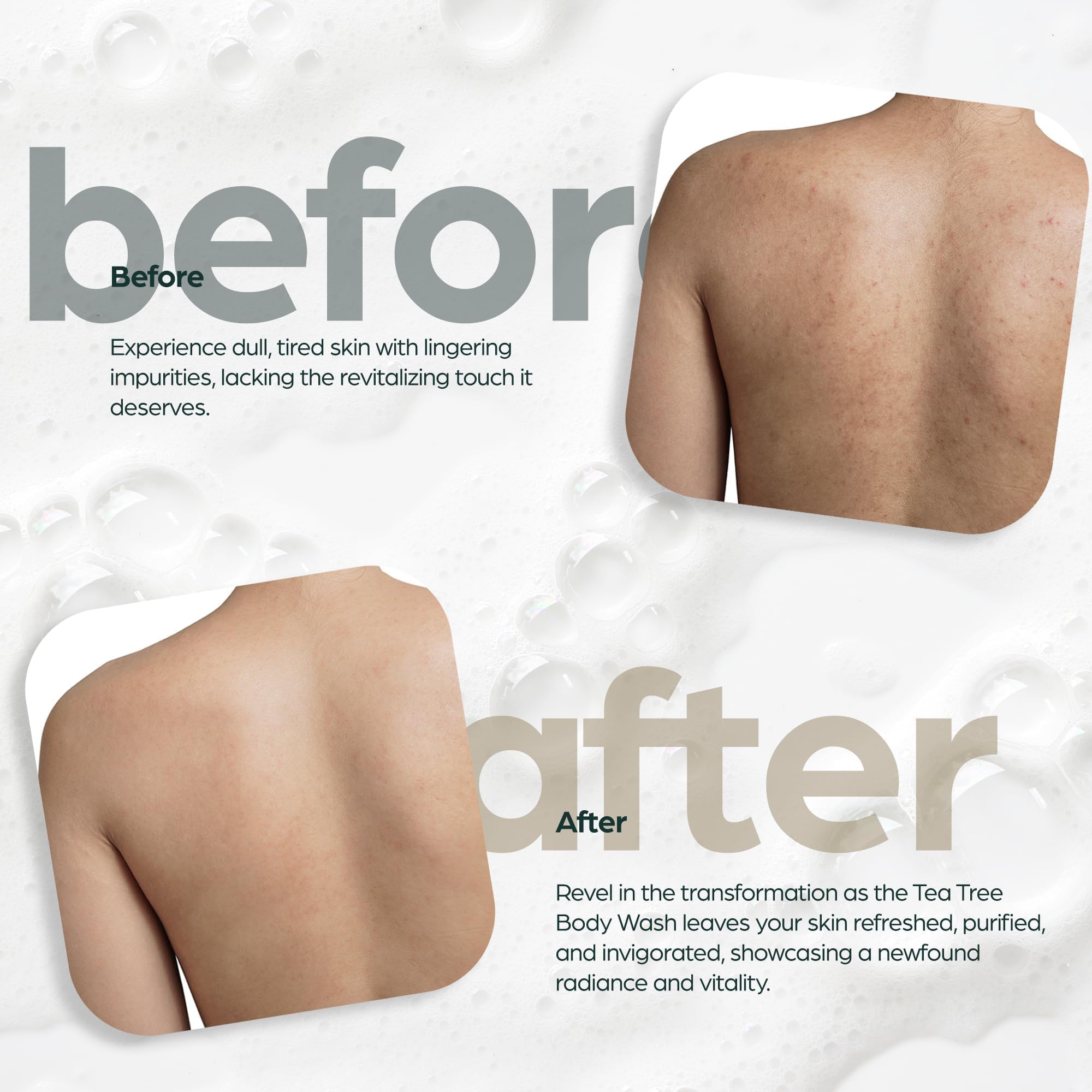 Artnaturals Tea Tree Oil Body Wash soothes eczema-prone areas.