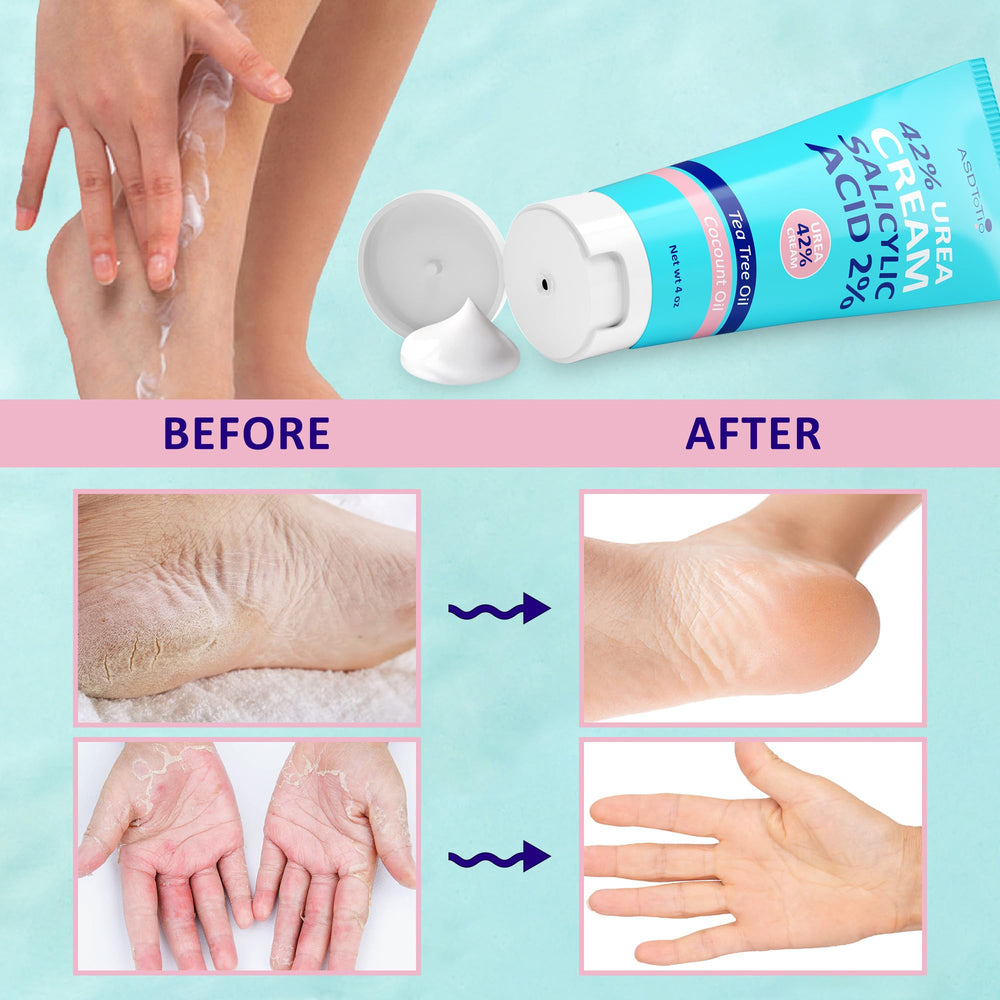 ASDToTio Urea Cream 42% being applied for foot care routine
