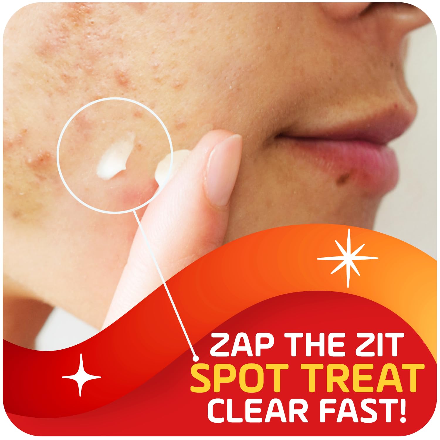 Asepxia spot-treatment applied on skin targeting a blemish.