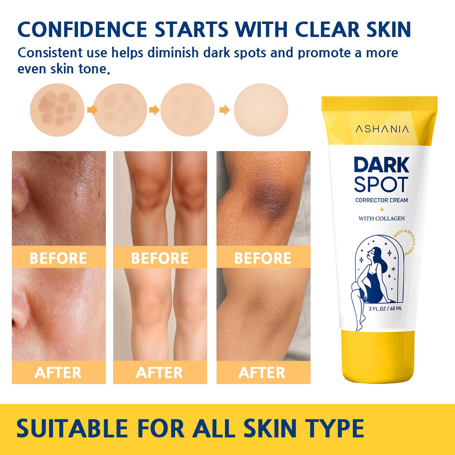 Ashania Inner thigh dark spot treatment demonstrates targeted use.
