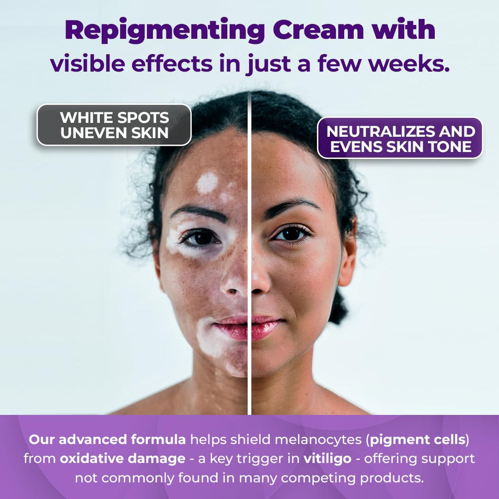 Aura Dermacare Vitiligo Cream jar with swatch indicating even tone progress.