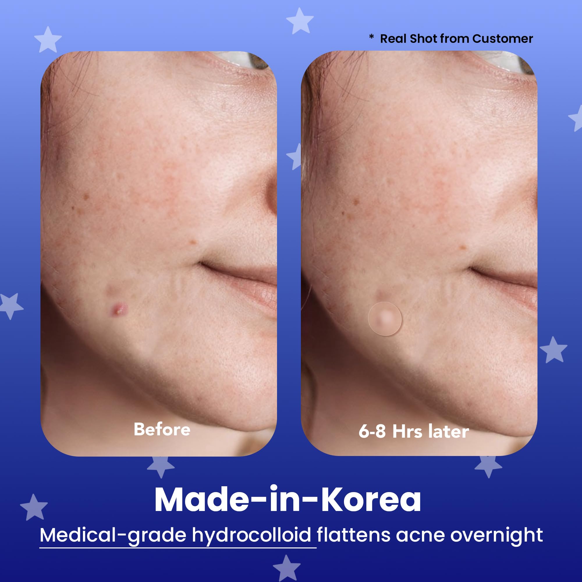 AVARELLE hydrocolloid patches with tea tree oil support discreet blemish care