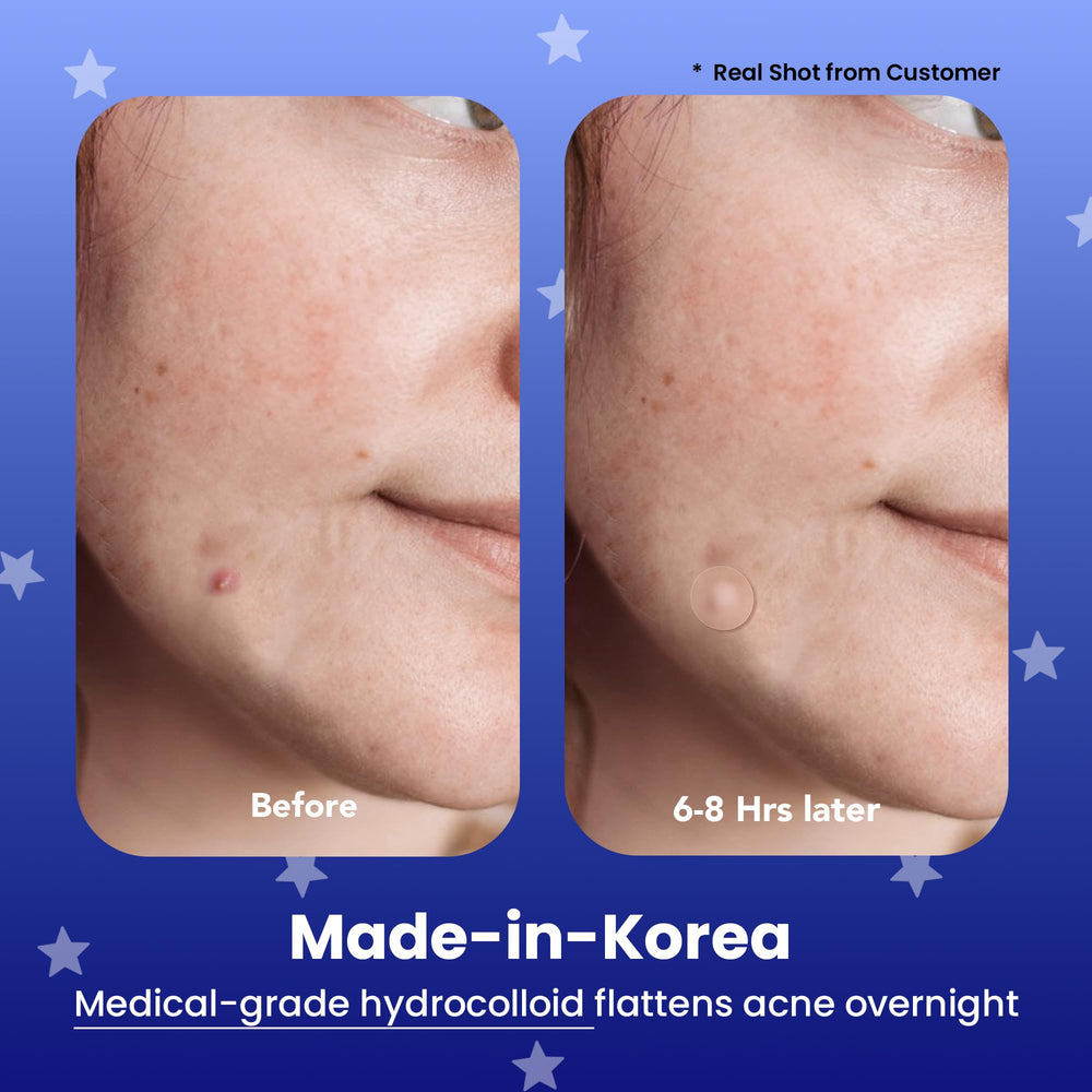 AVARELLE hydrocolloid patches with tea tree oil support discreet blemish care