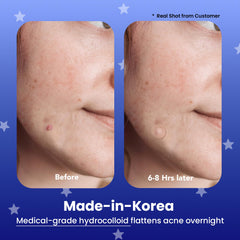 AVARELLE hydrocolloid patches with tea tree oil support discreet blemish care
