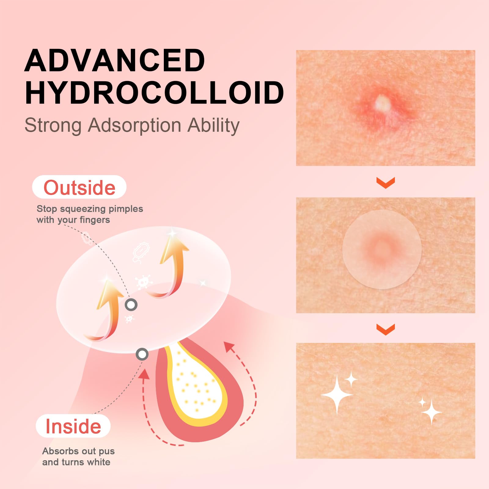 AVJONE hydrocolloid patch adheres to skin for discreet daily wear.