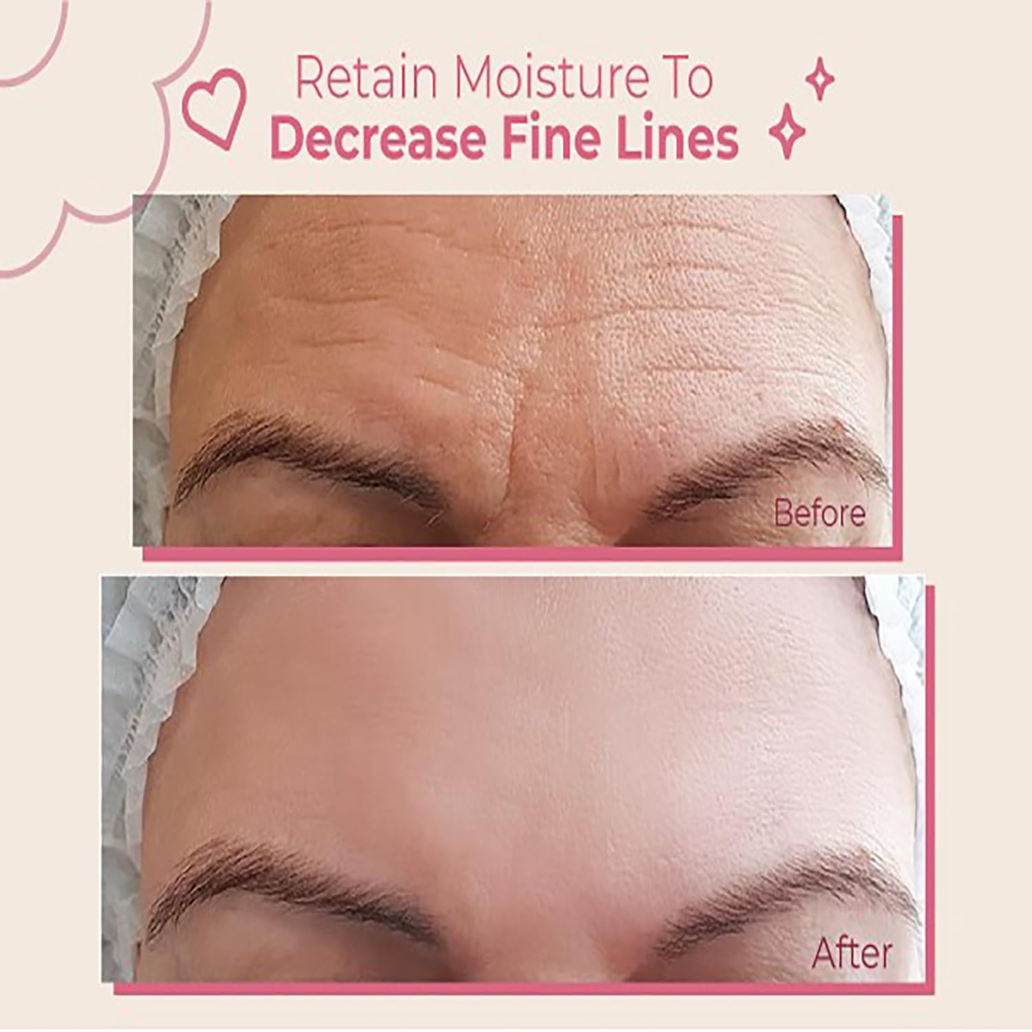 Bayside forehead wrinkle patches in use on the brow for wrinkle reduction