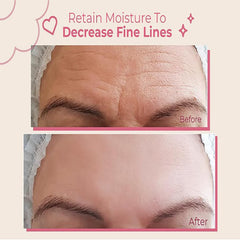 Bayside forehead wrinkle patches in use on the brow for wrinkle reduction