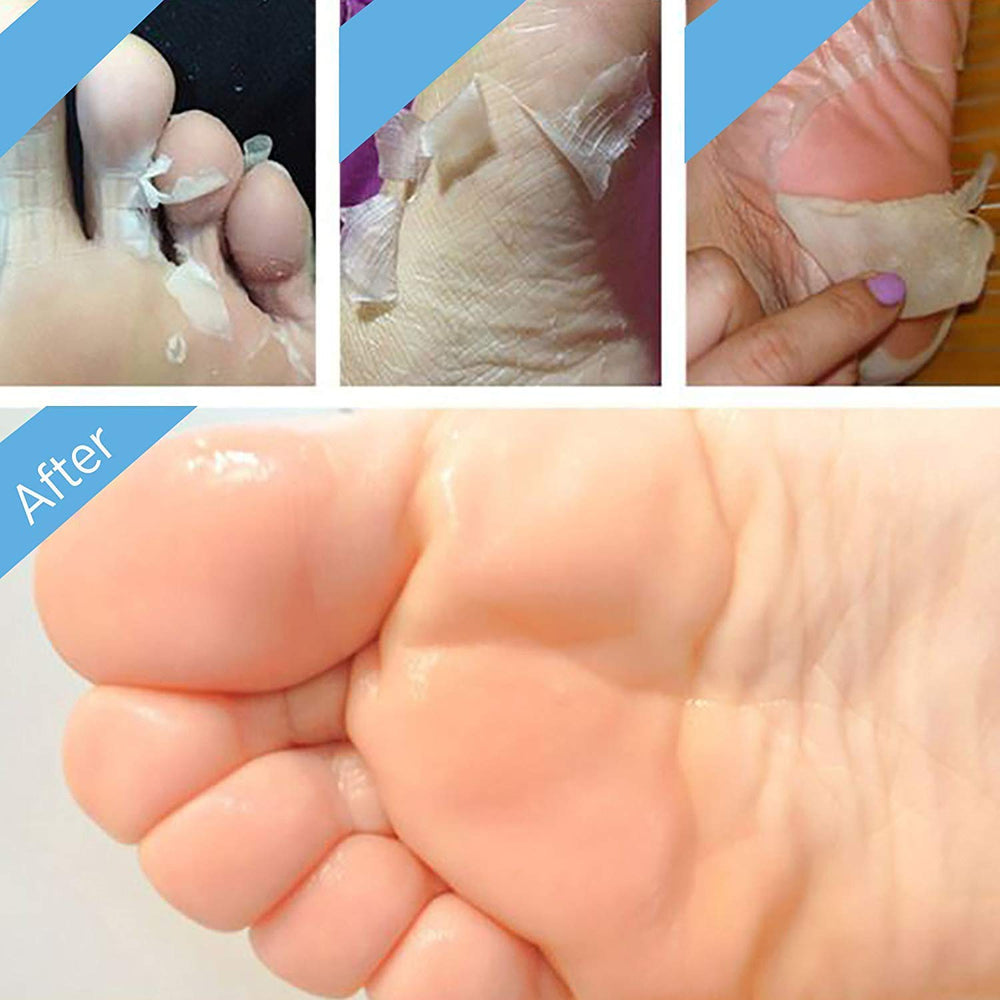 Bealuz dead skin removal close-up, showing peeling process and renewal.