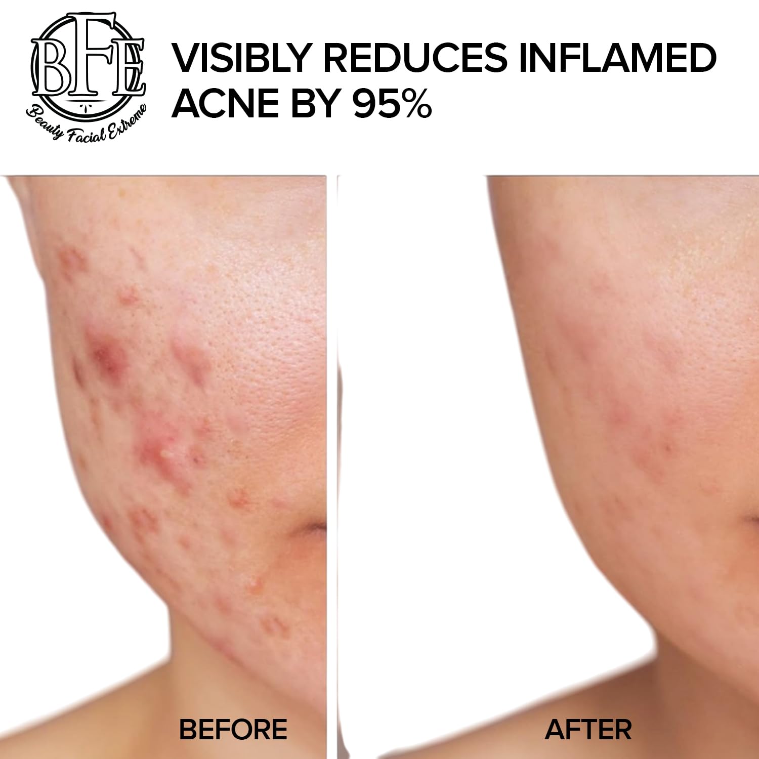 Face after using Beauty Facial Extreme Acne Pads shows refreshed hydration.