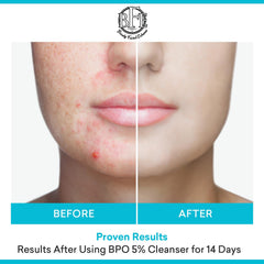 Beauty Facial Extreme benzoyl peroxide wash pump dispenser ready for easy daily use
