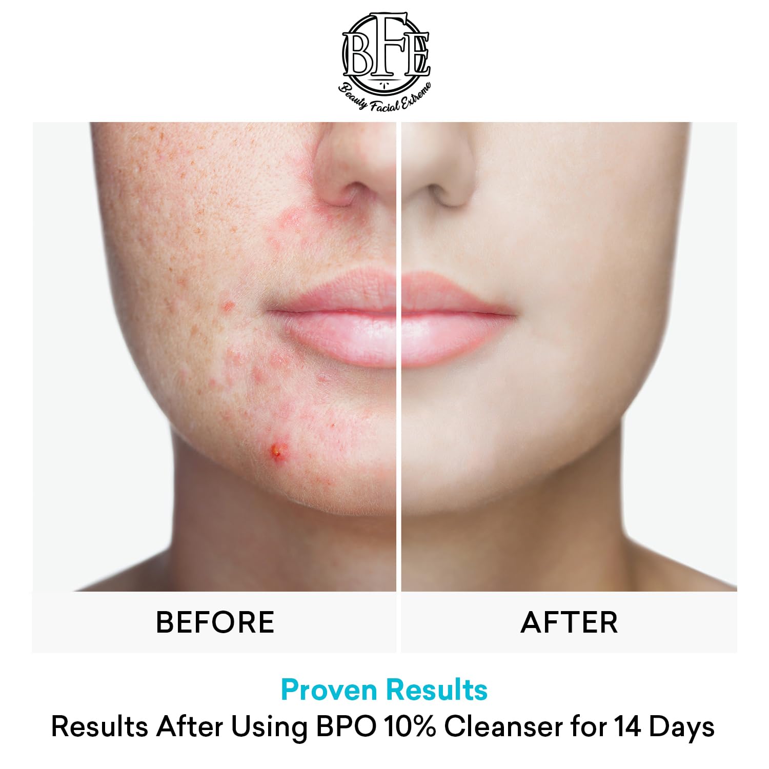 Beauty Facial Extreme bottle suitable for face and body acne care.