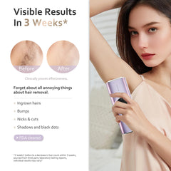 BeautyGlow underarm hair removal with IPL technology