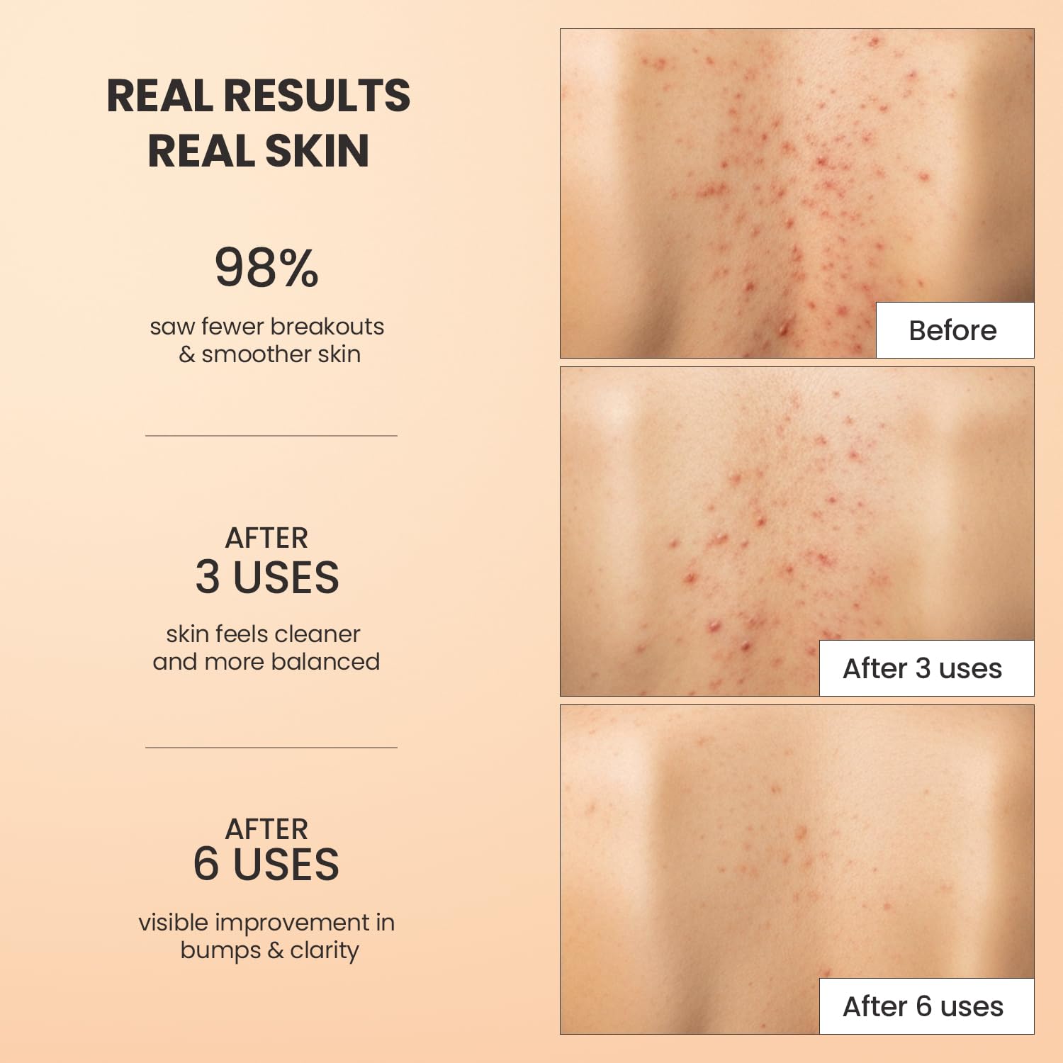 BellamiLuxx body acne scrub butt: helps smooth skin and reduce buildup.