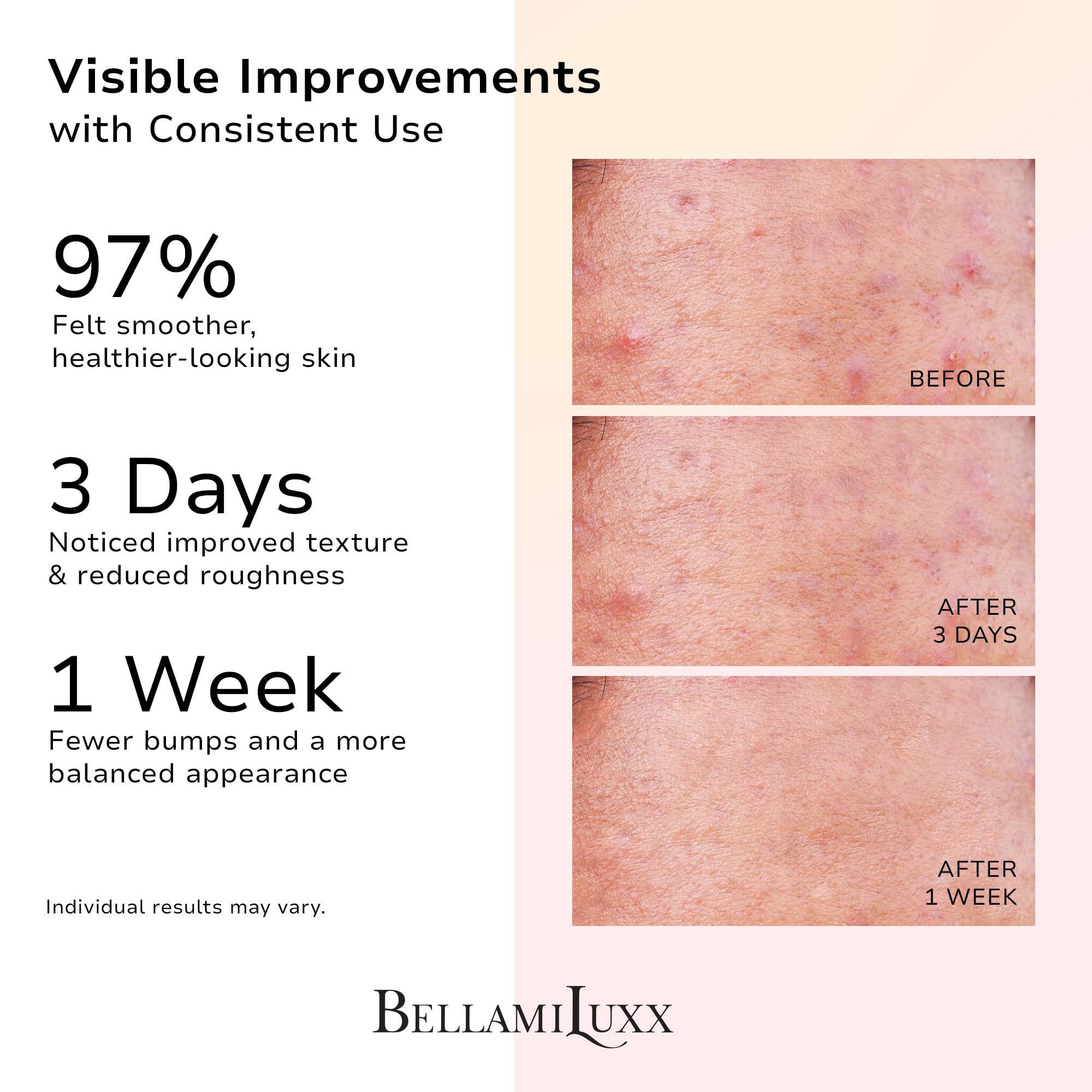BellamiLuxx butt acne soap bar packaging suggesting a clean daily routine