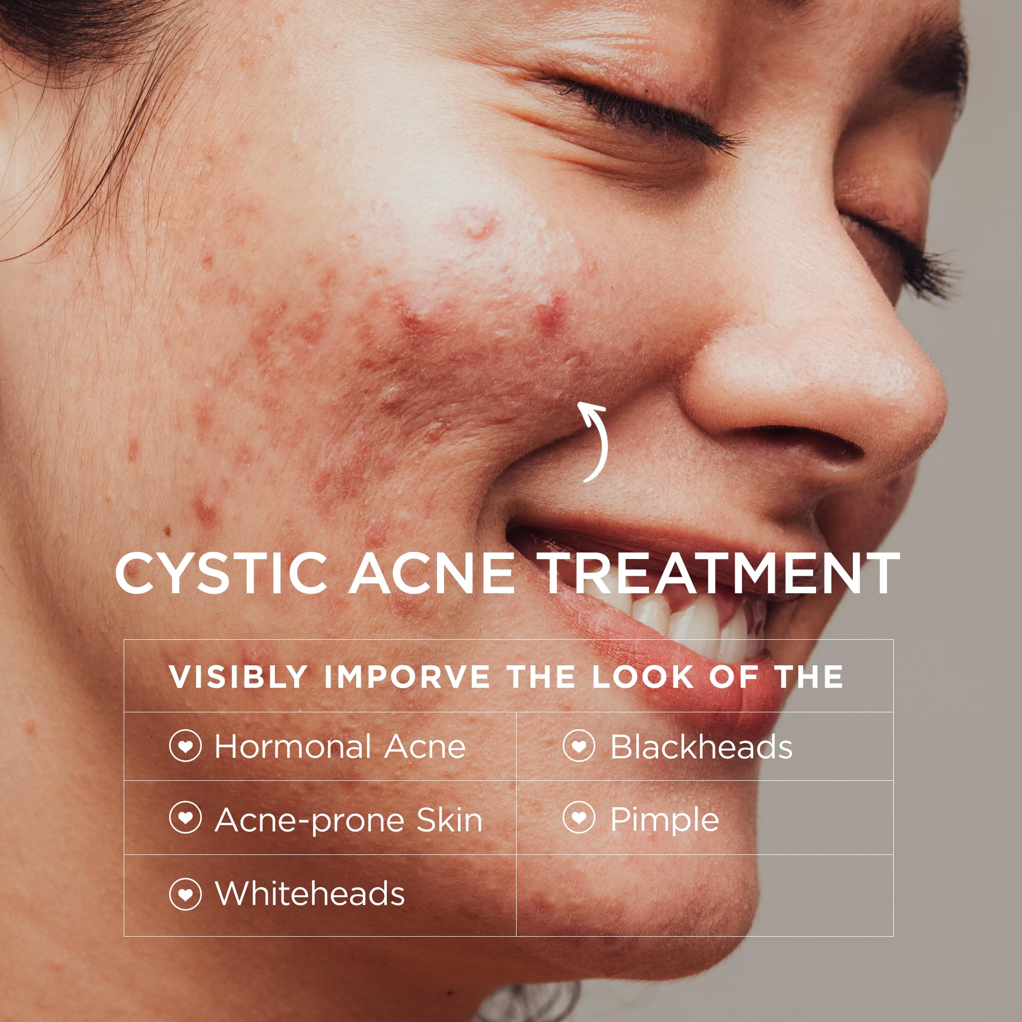 BellamiLuxx cystic acne lotion jar showing gentle daily application for teens and adults.