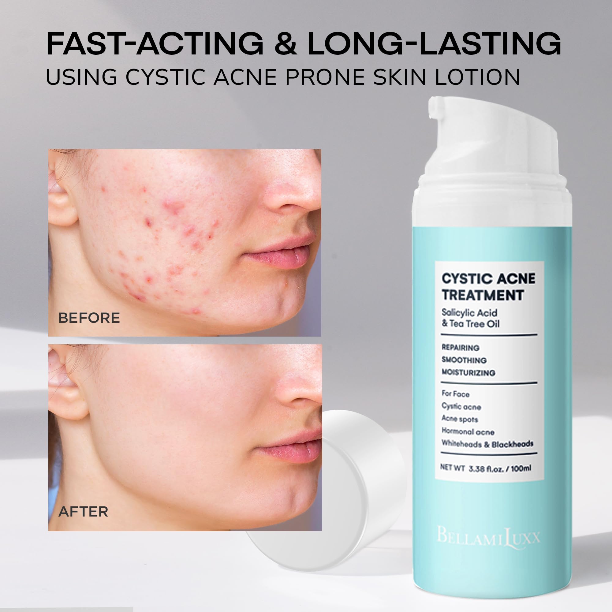 BellamiLuxx cystic acne lotion ingredients tea tree oil for soothing skin balance.
