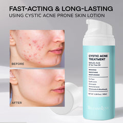 BellamiLuxx cystic acne lotion ingredients tea tree oil for soothing skin balance.