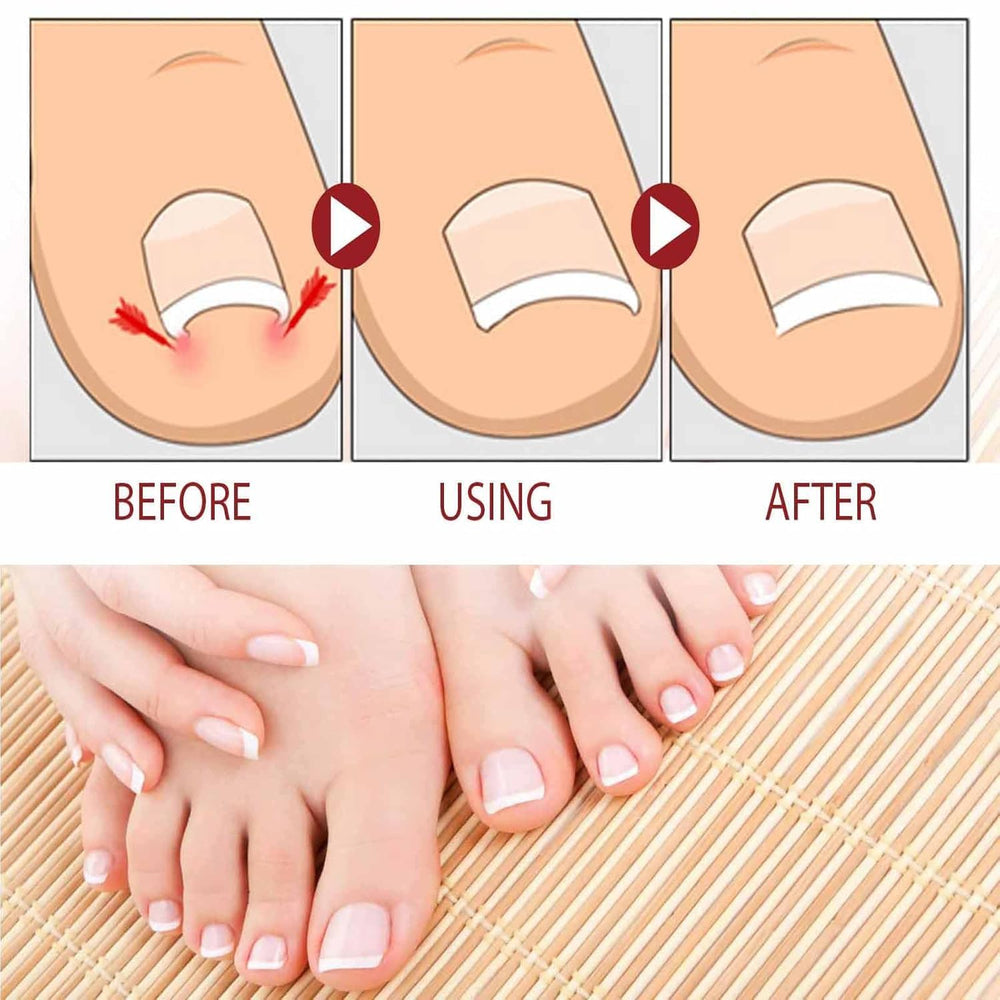 Beuifvo Travel-Size Nail Care Kit fits in bags for quick care.