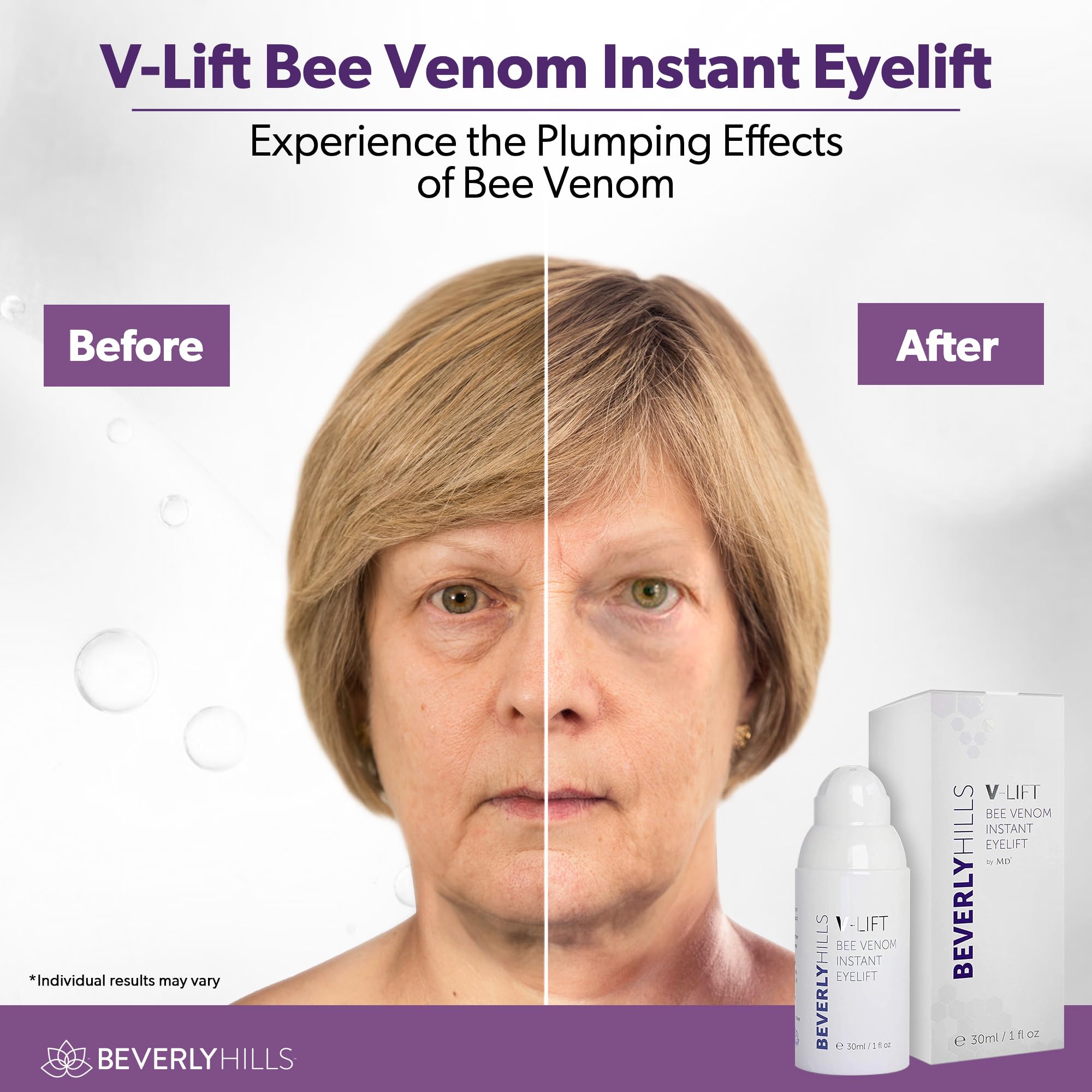 Beverly Hills V-Lift eye-area close-up showing brightened under-eye