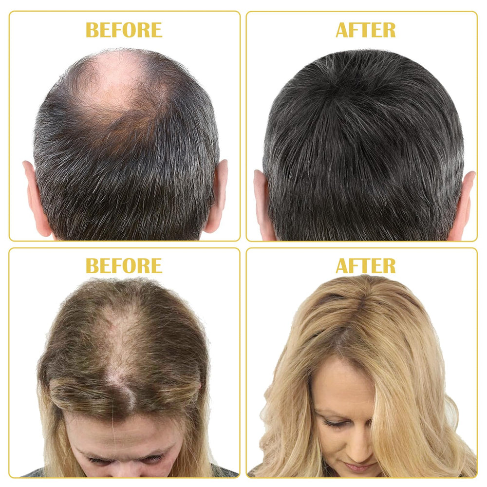Bieyoc Minoxidil Growth Serum packaging opened for one month supply.