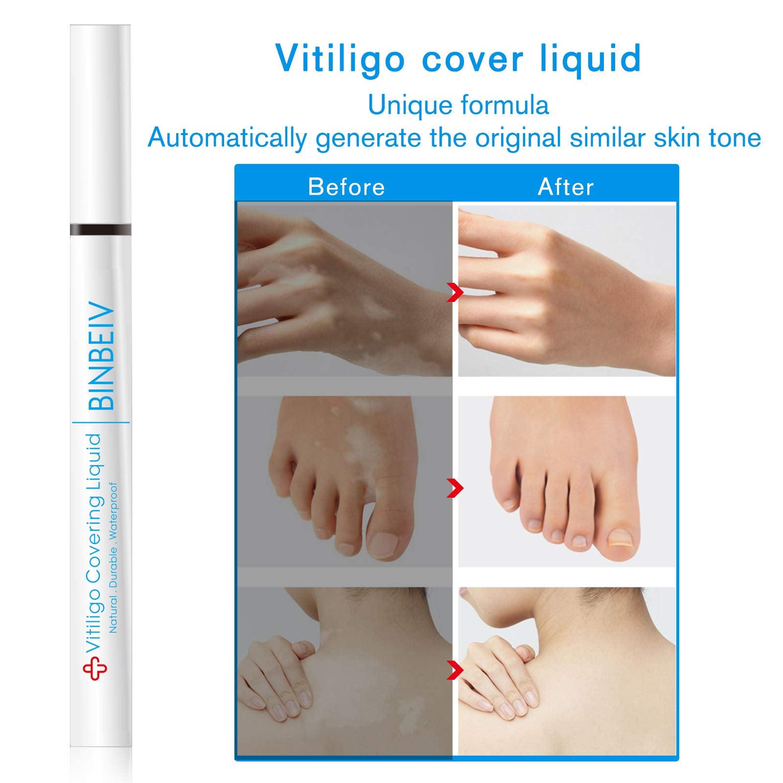 BINBEIV Vitiligo Cover Liquid face application enables quick concealment of depigmented areas