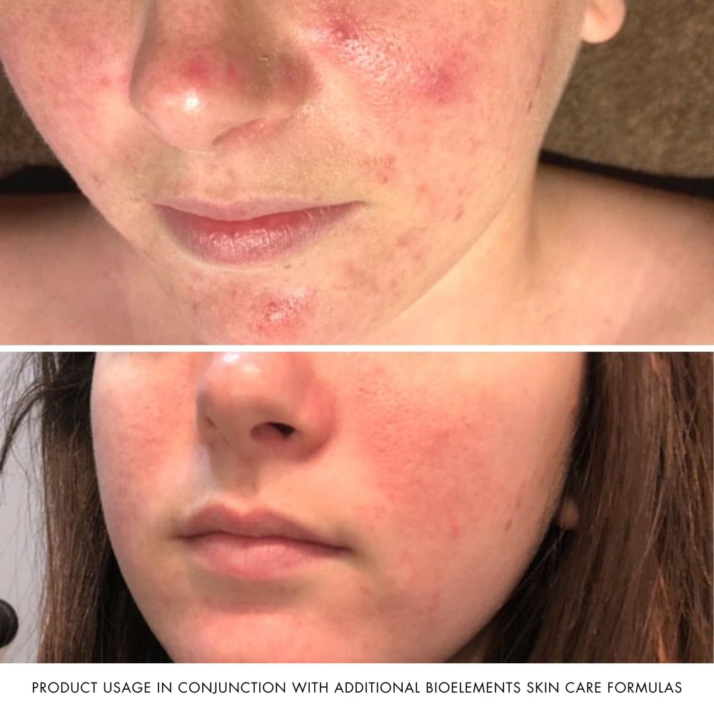 Part of a daily routine for pore refinement and oil balance.
