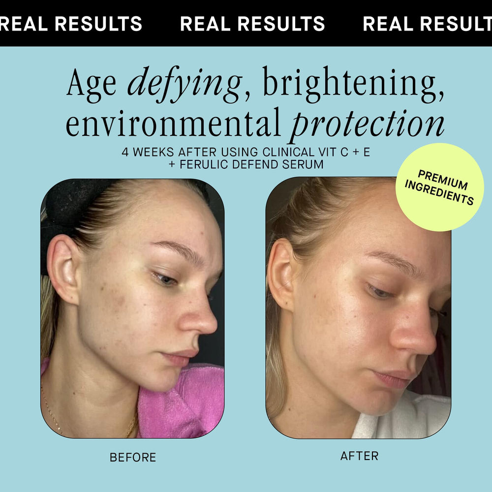 Image shows fading dark spots with Brandefy Vitamin C Serum usage