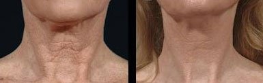 Transparent stickers blend with skin for subtle, natural-looking neck enhancement.