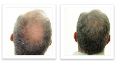 Caboki apply-on thinning area demonstrates quick natural-looking coverage