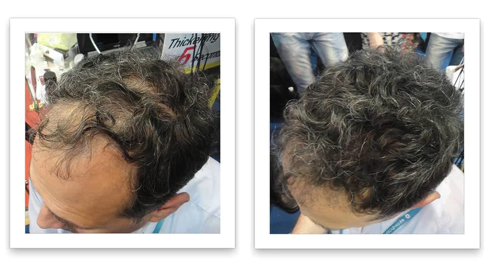 Caboki fibers blend with thinning areas for natural coverage.