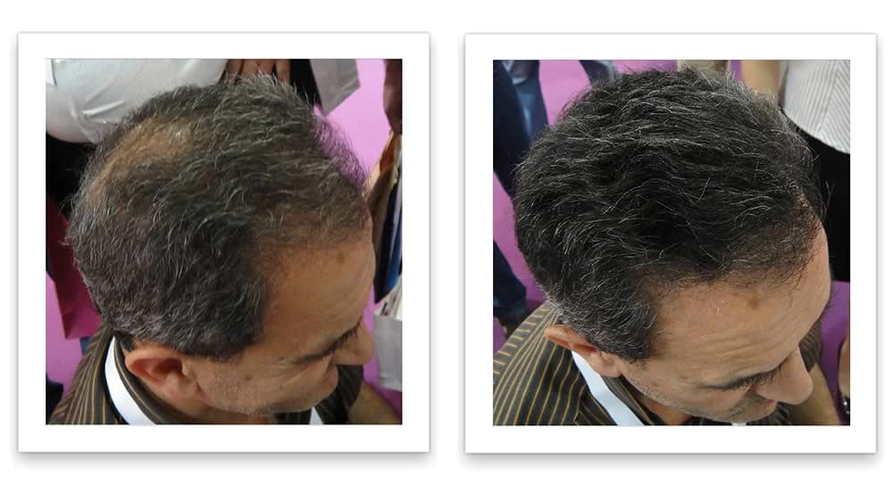 Salt & Pepper-Dark shade from Caboki blends with gray hair.