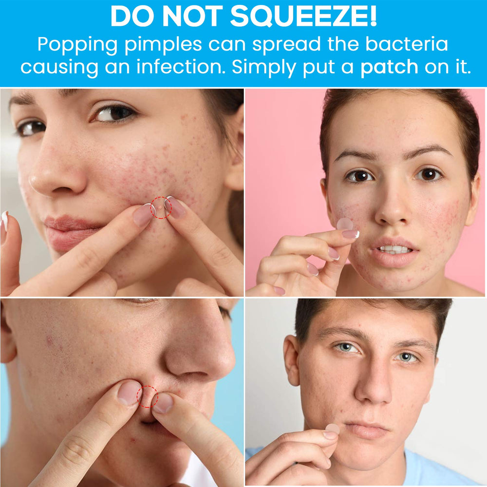Care Me acne patch designed for overnight use to support blemish care.