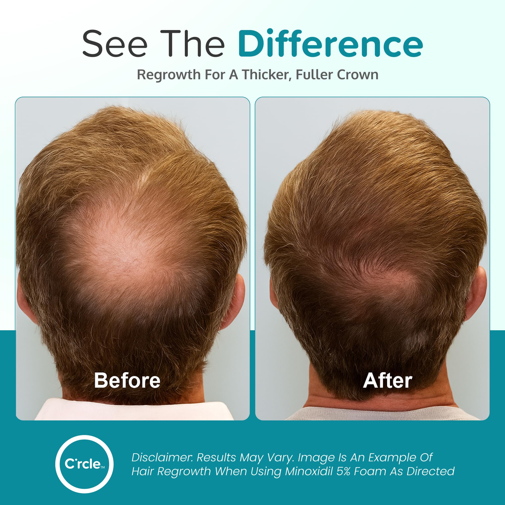 C'rcle Minoxidil Foam 5% unscented foam applied to scalp
