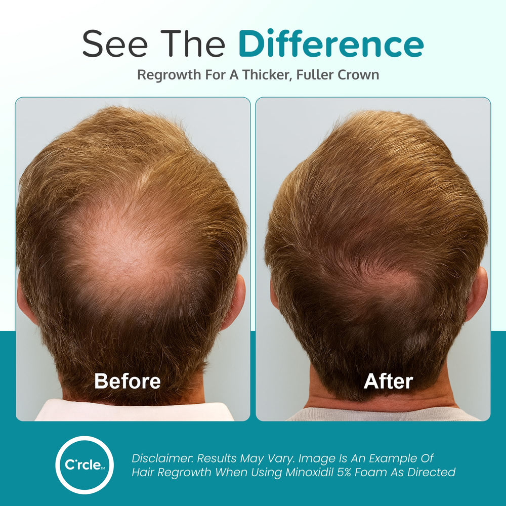 C'rcle Minoxidil Foam 5% unscented foam applied to scalp