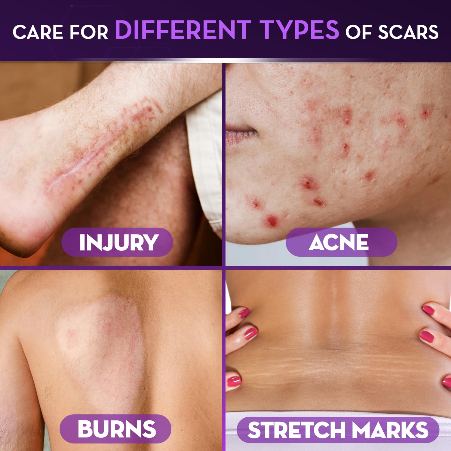Cicatricure Advanced Scar Gel on face showing hydration and smoothing.