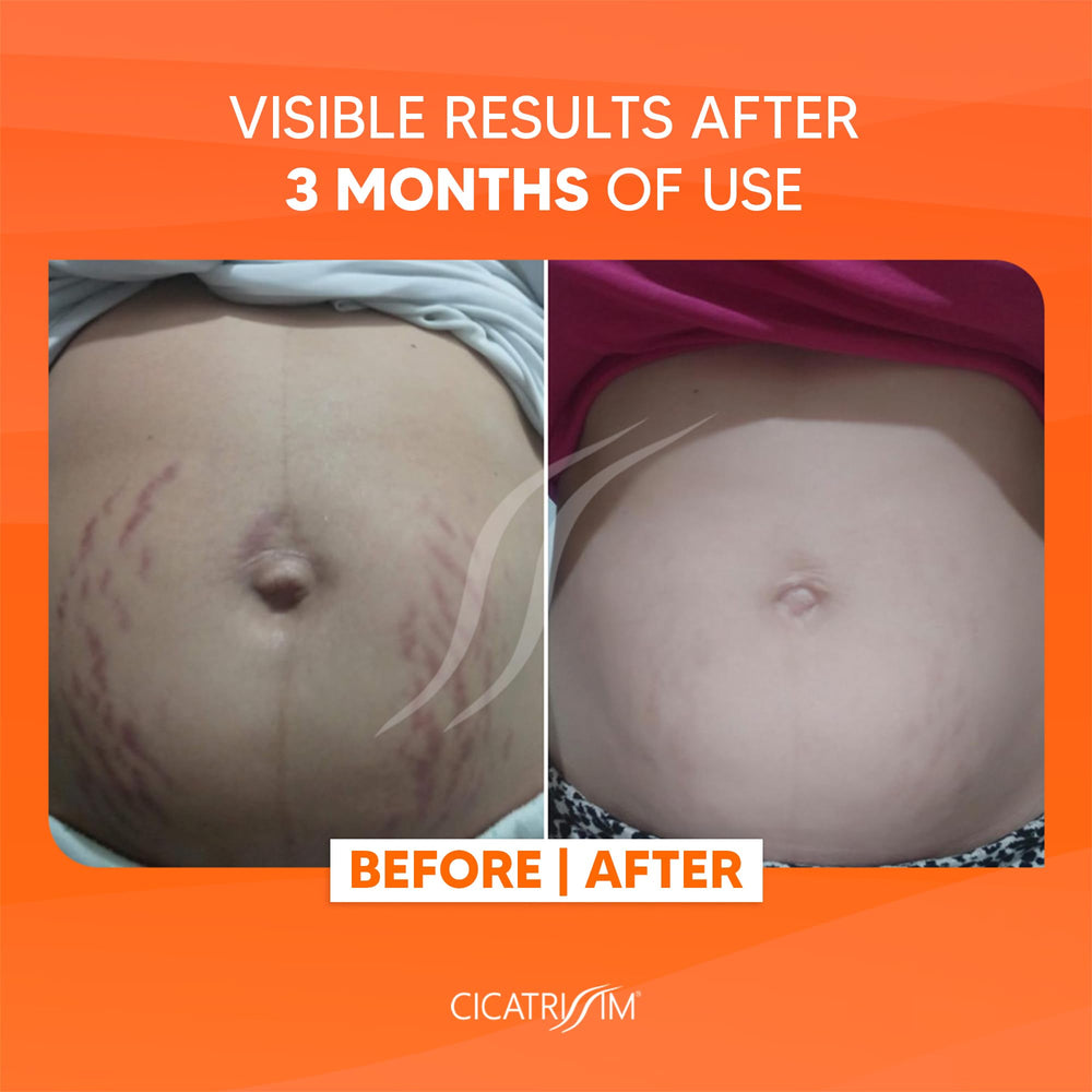 Applying Cicatrissim on the abdomen for even skin tone