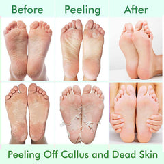 CMWGKBC Foot Peel Mask before-after shows potential skin renewal.