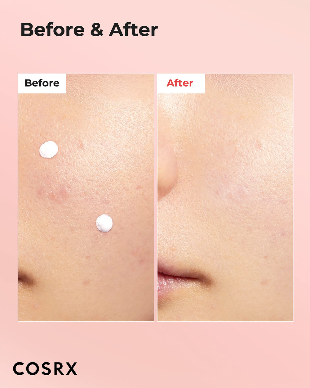 Close-up of lotion dispense showing precise application for pimples with quick absorption.
