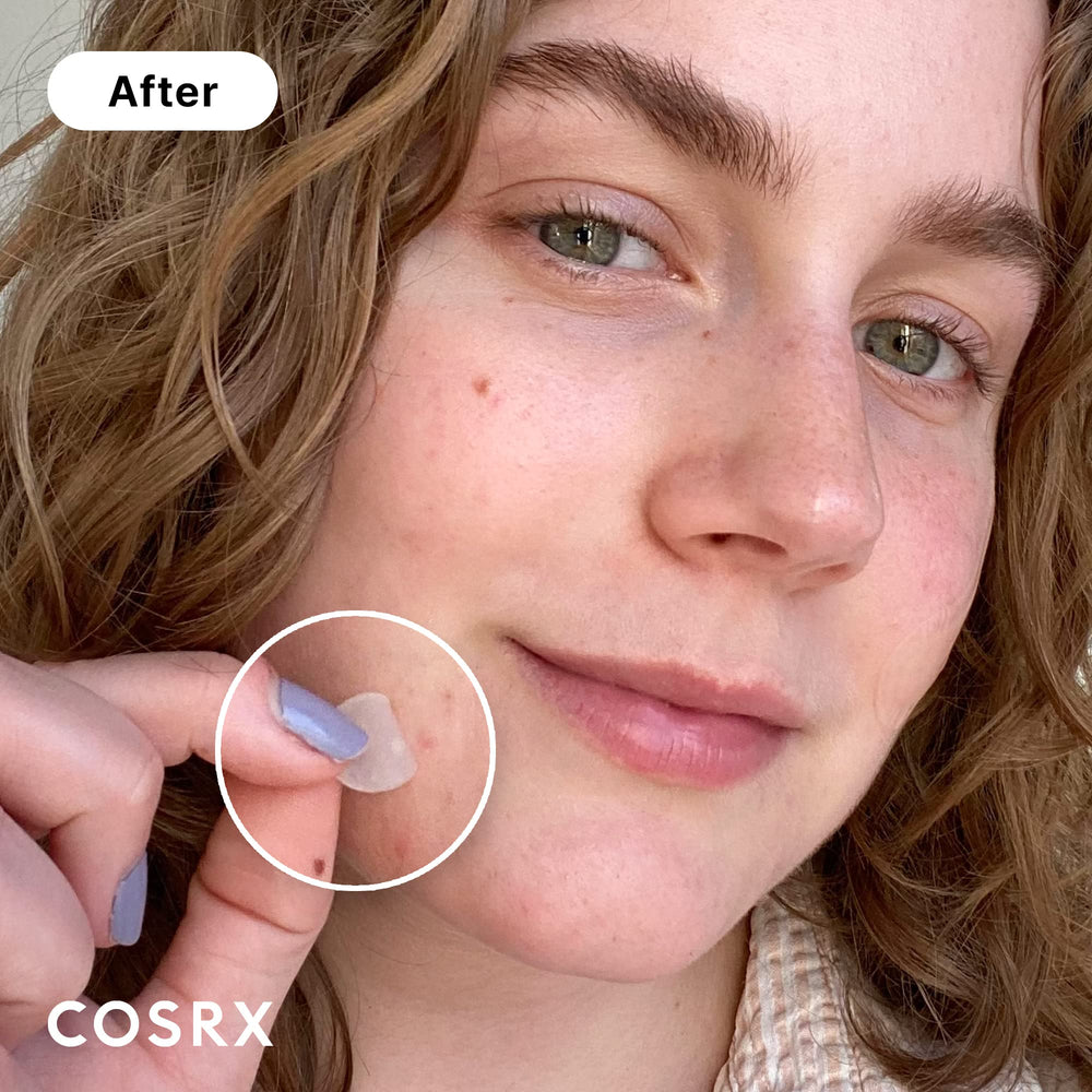 COSRX Acne Patch being applied on a zit for discreet protection.